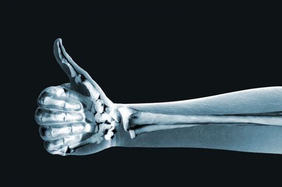 X-ray digunakan untuk mendiagnosis kesakitan pada sendi jari
