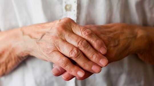 rheumatoid arthritis sebagai punca kesakitan pada sendi jari