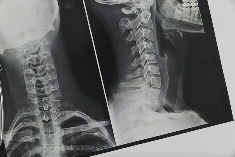 X-ray tulang belakang serviks yang terjejas oleh osteochondrosis
