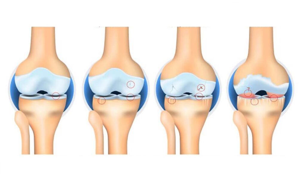 Peringkat osteoarthritis sendi lutut