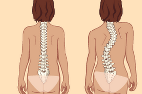 postur tegak dan scoliosis dengan osteochondrosis toraks