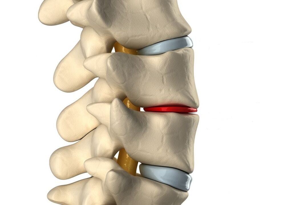 Cakera intervertebral yang sihat (biru) dan rosak oleh osteochondrosis toraks (merah)