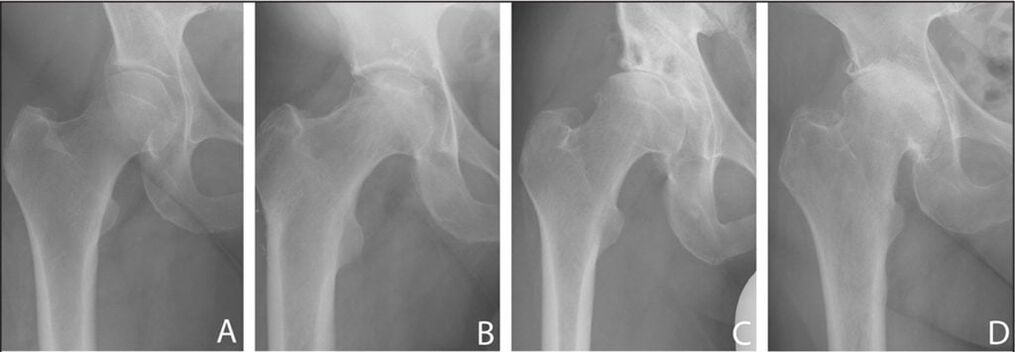 Peringkat perkembangan osteoarthritis sendi pinggul pada x-ray