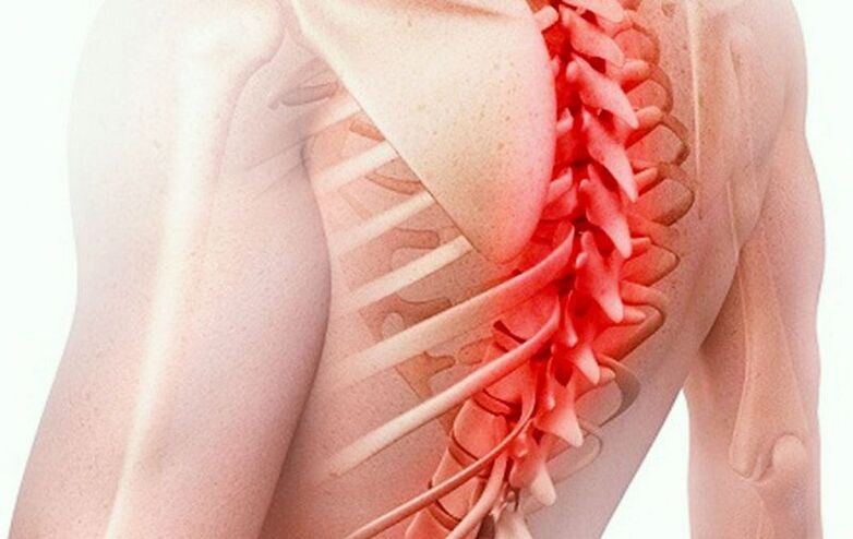 Osteochondrosis tulang belakang toraks
