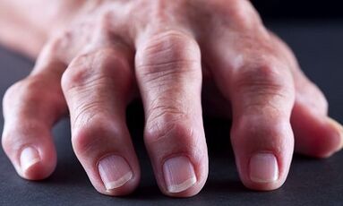 Apakah perbezaan antara arthritis kerana arthrosis