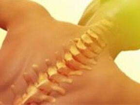 Osteochondrosis - Penyakit tulang belakang
