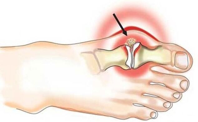 Keradangan sendi antara ibu jari kaki dan kaki akibat arthritis