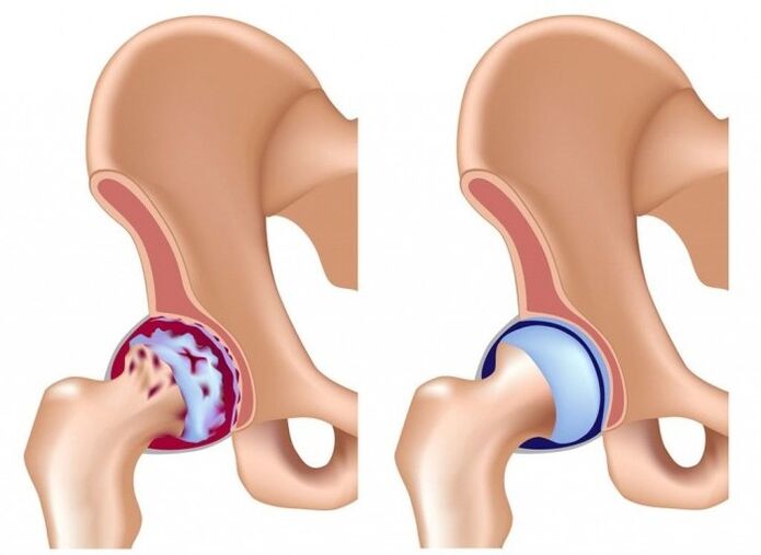 Kerosakan pada sendi pinggul akibat osteoarthritis
