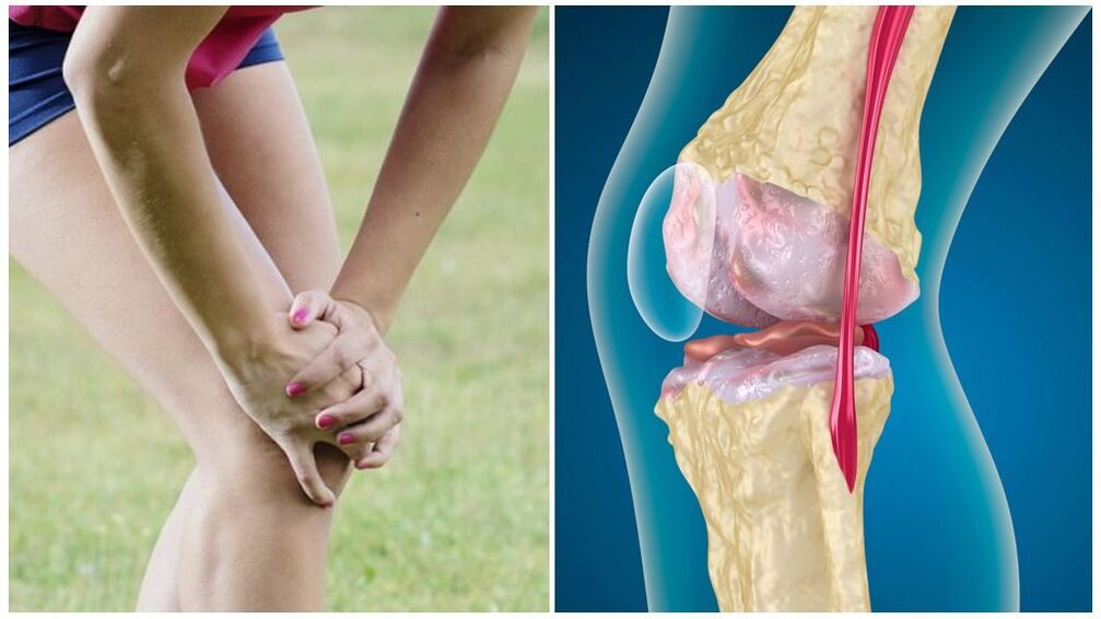 Gejala osteoarthritis