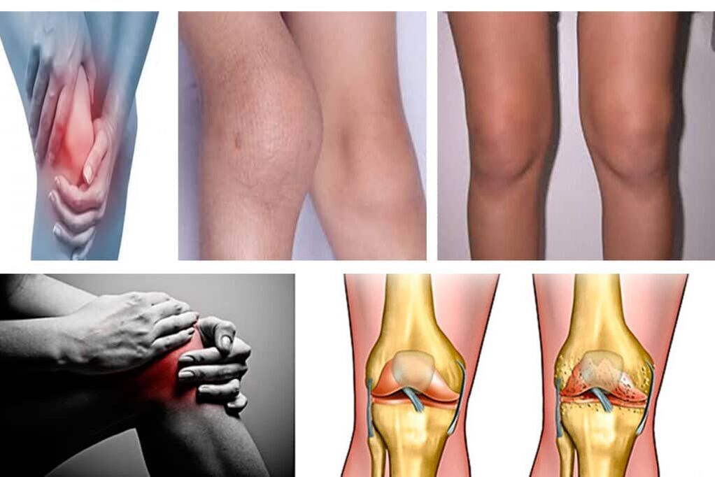 Osteoartritis, apakah itu