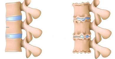 Cara mengenali kehadiran osteochondrosis tulang belakang lumbar