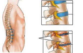 Punca osteochondrosis tulang belakang lumbar