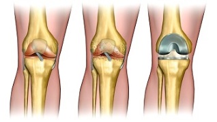 Endoprosthetics untuk osteoartritis sendi lutut